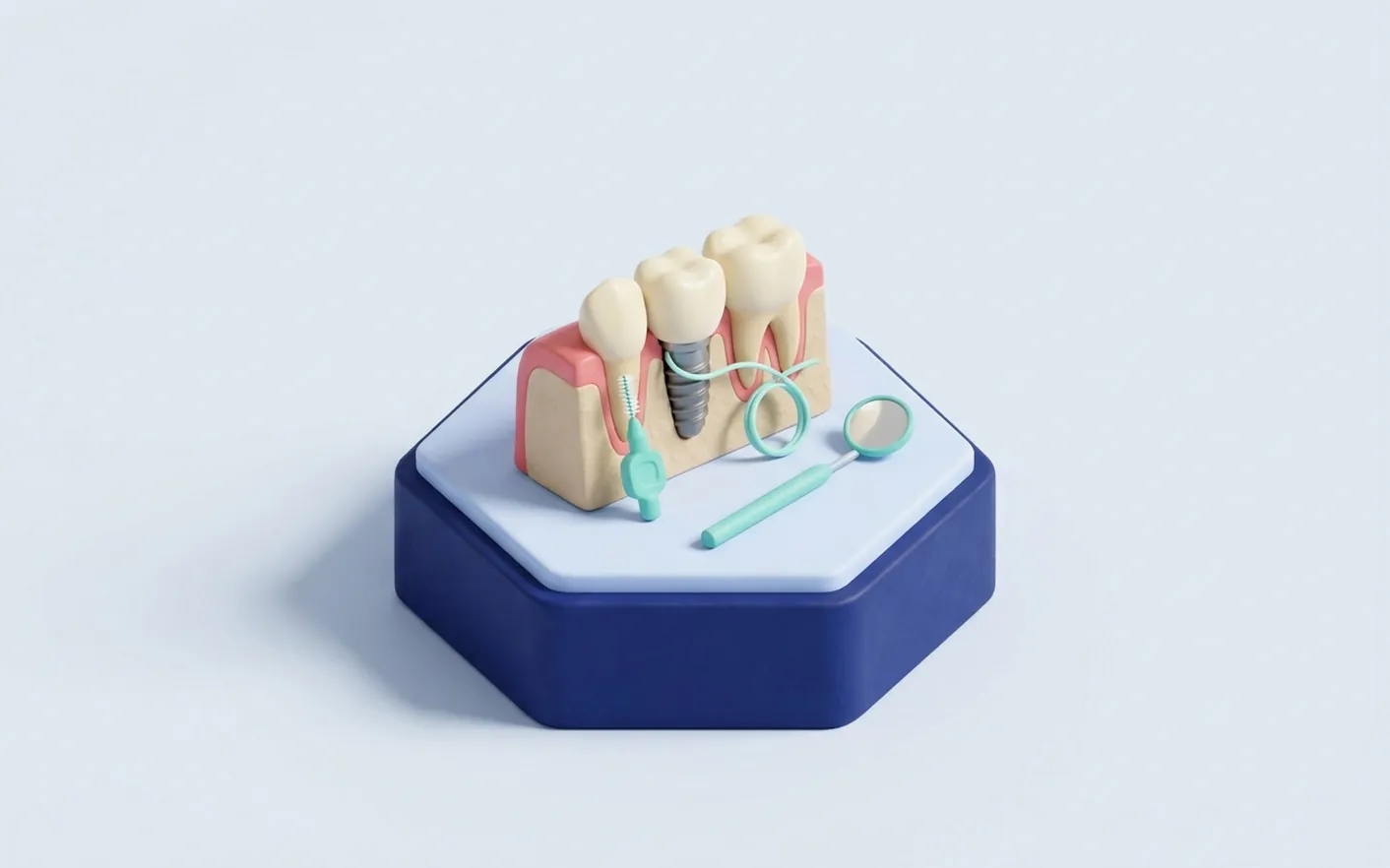 Cos'è la perimplantite e quali sono i segnali? Foto dello studio di Via Tripoli.